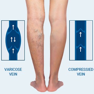 MD 23-32mmHg Microfiber Compression Thigh High Stockings